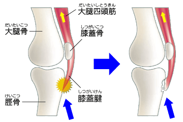 osgood_schlatter_01.gif
